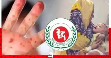 হাম উপসর্গে আরও ৬ শিশুর মৃত্যু