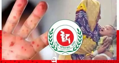 হাম ও উপসর্গে আরও ৫ শিশুর মৃত্যু