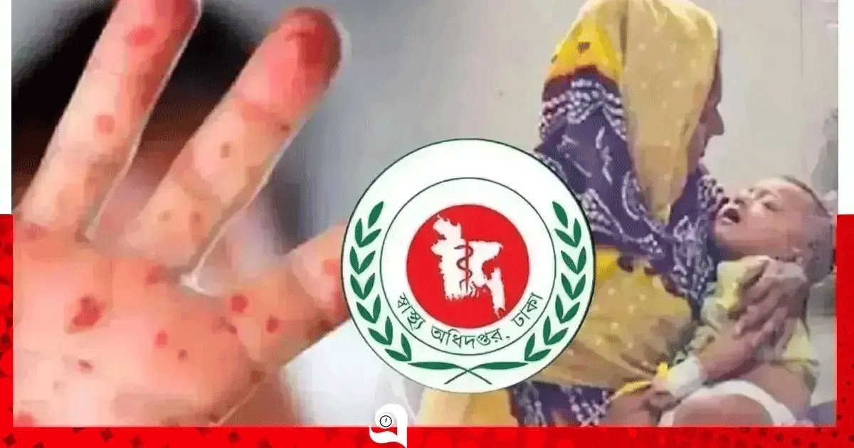 হাম উপসর্গে আরও ৬ শিশুর মৃত্যু