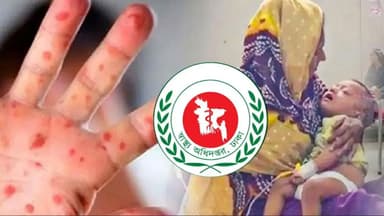 হাম ও উপসর্গে আরও ৬ শিশুর মৃত্যু