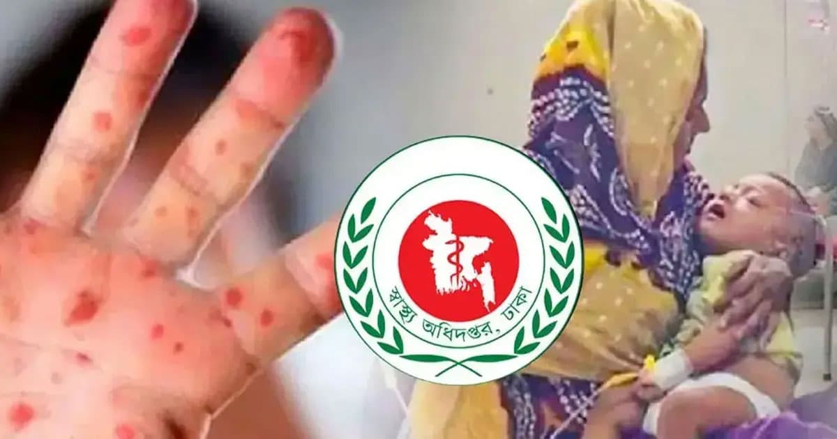 যেভাবে ছড়ায় হাম
