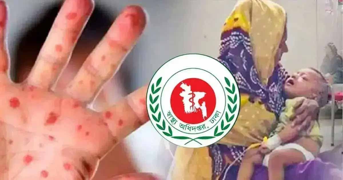 হাম ও উপসর্গে আরও ৩ শিশুর মৃত্যু