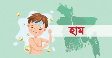হাম উপসর্গে আরও ৮ শিশুর মৃত্যু