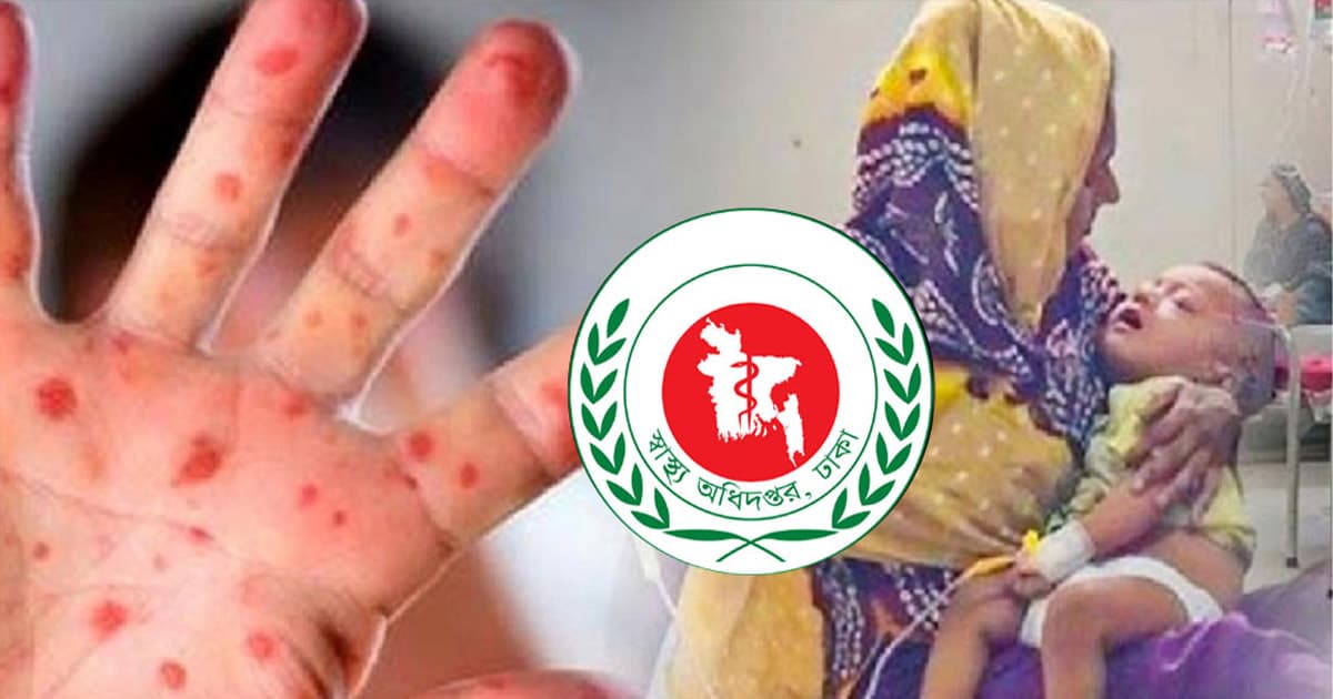 হাম উপসর্গে আরও ৫ শিশুর মৃত্যু, আক্রান্ত ১১১৯