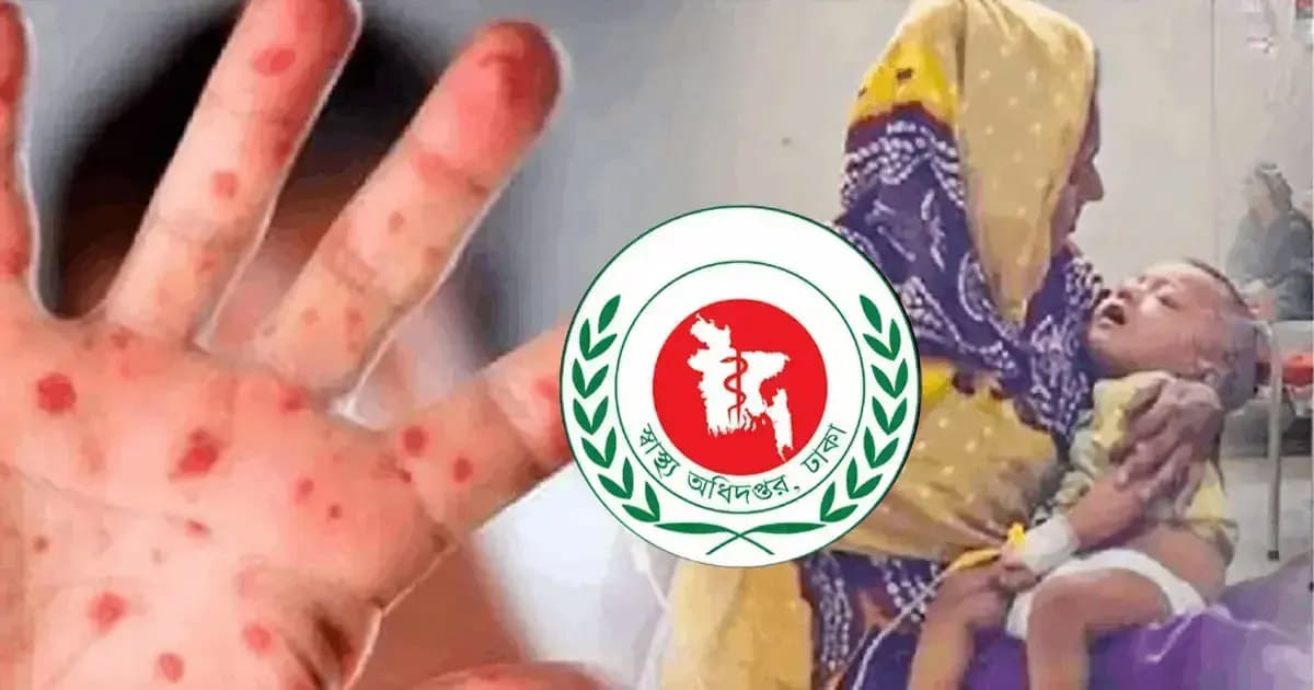 হাম উপসর্গে আরও ৭ শিশুর মৃত্যু