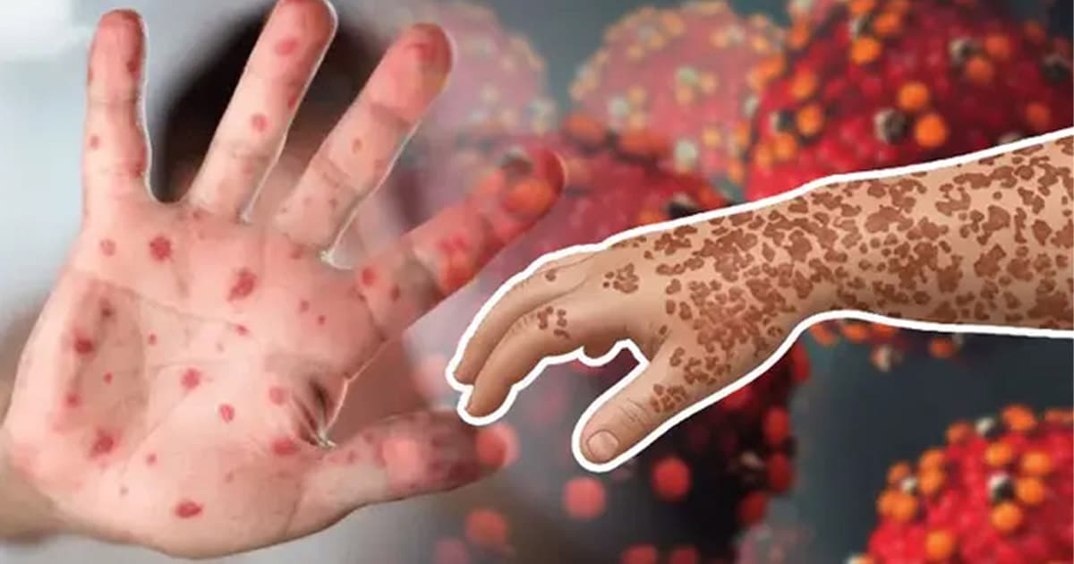 হাম উপসর্গে আরও ৪ শিশুর মৃত্যু, আক্রান্ত ১১৪৫