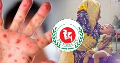 হাম উপসর্গে আরও ১৬ শিশুর মৃত্যু