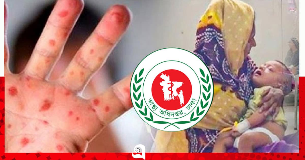 হাম উপসর্গে আরও ৬ শিশুর মৃত্যু