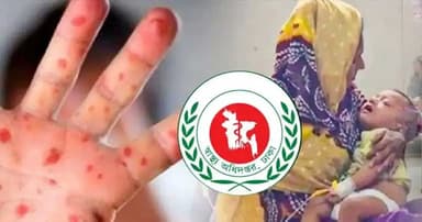 হাম উপসর্গে আরও ৭ শিশুর মৃত্যু