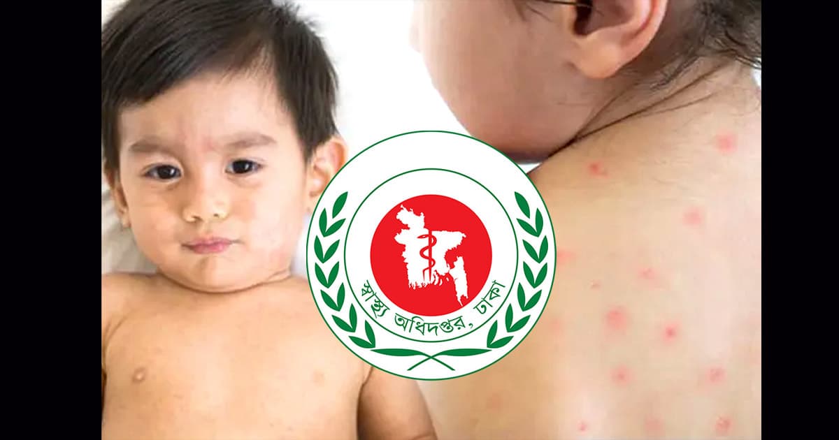 ২৪ ঘণ্টায় হামে আক্রান্ত ও উপসর্গে মৃত্যু ৭